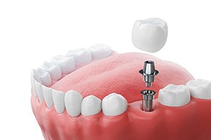 A single dental implant with abutment and crown