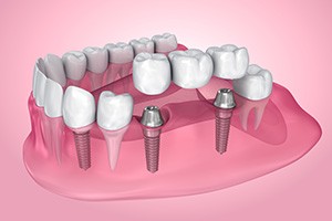 Illustration of a dental implant bridge