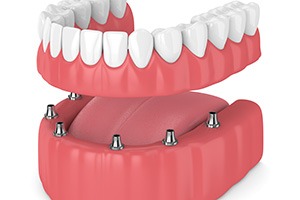 Illustration of full implant denture for lower arch