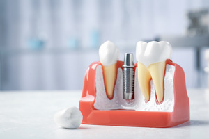 Model of dental implant between natural teeth