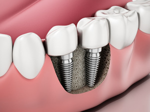 Illustration of a dental implant in the jawbone