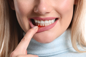 Close-up of woman smiling and showing signs of gum disease