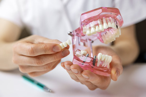 Dentist holding a model of teeth with dental implants