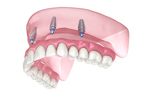 Illustration of All-on-4 dental implants