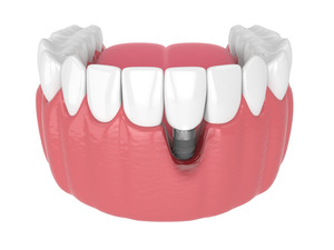 Illustration of gum recession around failed dental implant