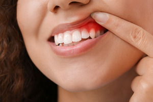 Woman pulling up lip to show signs of gum disease