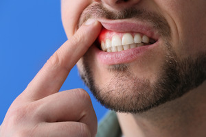 Bearded man pulling up lip to show signs of gum disease