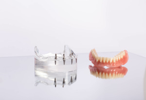 Dentures sitting next to plastic model with dental implants