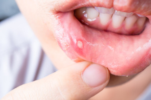 Pulling down lip to show a canker sore